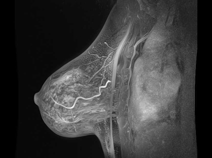 MRI画像（乳腺）
